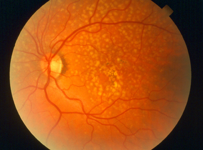 Macular degeneration